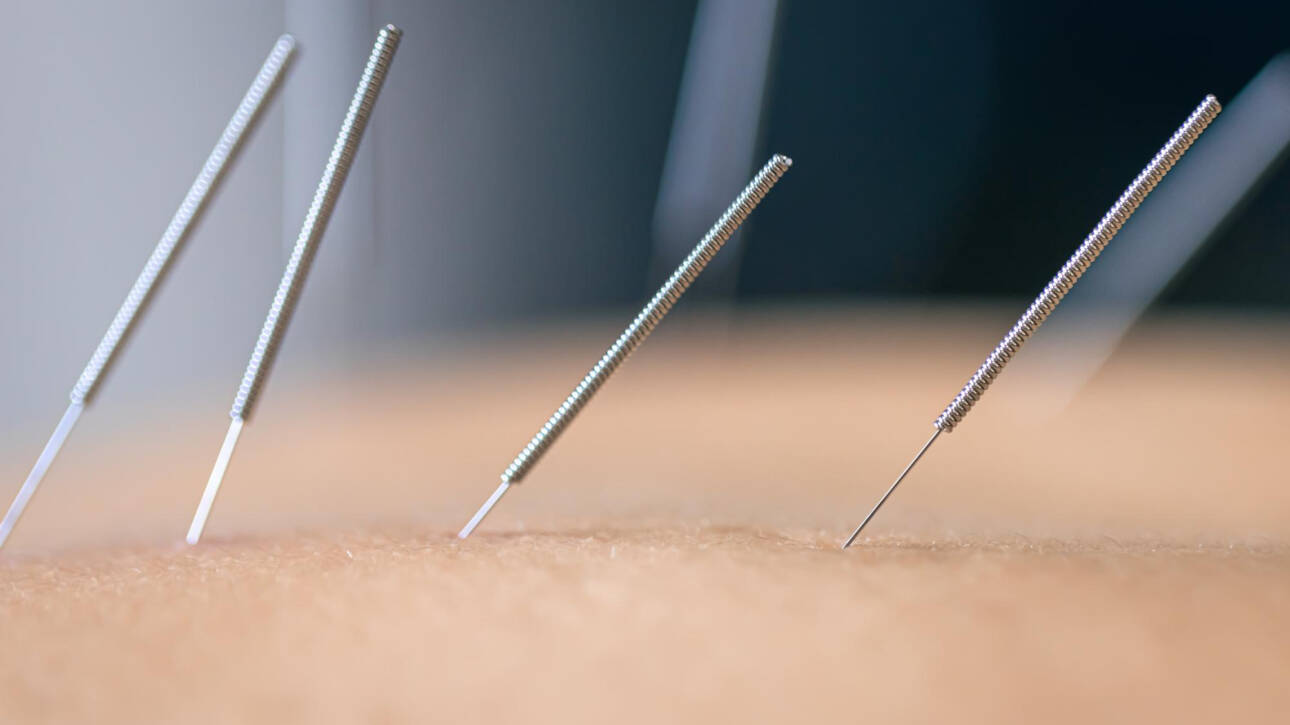 Acupuncture image